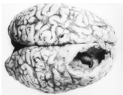 Человеческий кожный овод в мозге
