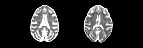 Сканирование мозга участников исследования показало, что "урезанная", но всё же полноценная по питательным веществам диета "сохраняет" больший объёма серого вещества (справа) (фото Sterling Johnson).