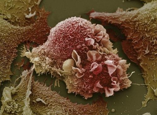 Клетки рака лёгких 