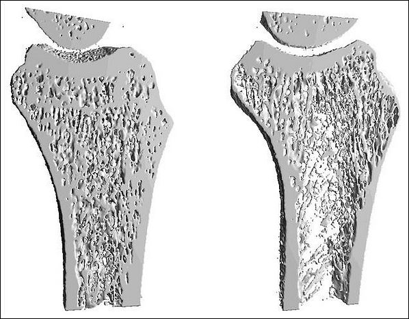 Компьютерная томограмма здоровой кости (слева) и кости, поражённой остеопорозом
