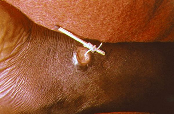 Традиционный метод состоит в извлечении паразита через разрез кожи, в ходе которого червя медленно наматывают на стержень. Процедура длится очень долго — до нескольких дней.