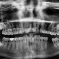 Почему зубы не считаются костью